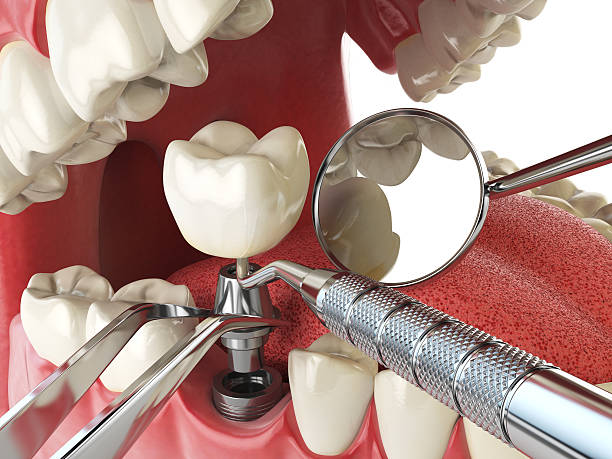 Best Emergency Root Canal Treatment in Purcell, OK